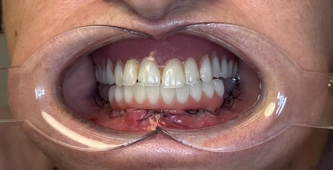 Transformare zâmbet la Denteca Smile Clinic Rezultat tratament stomatologic complex Denteca Smile Clinic București