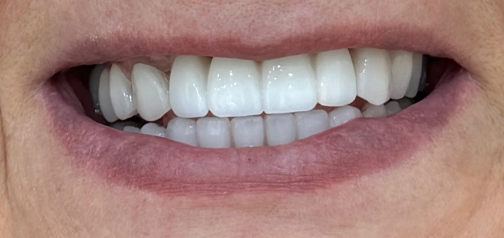 Zâmbet perfect după tratament Denteca Smile Rezultat tratament estetic dentar la Denteca Smile Clinic București