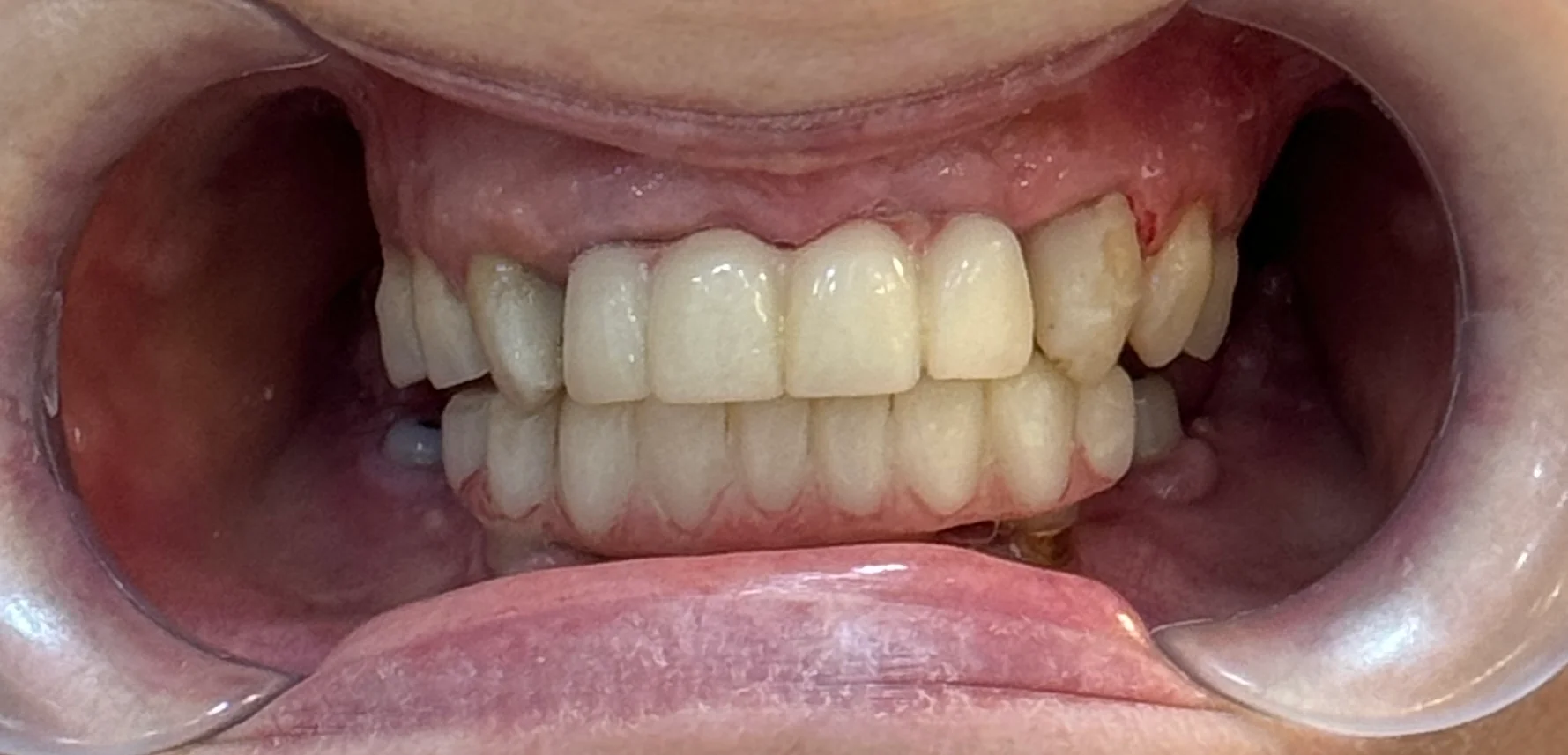 Denteca Smile Clinic - Caz înainte Aspect inițial dantură înainte de tratament la Denteca Smile Clinic