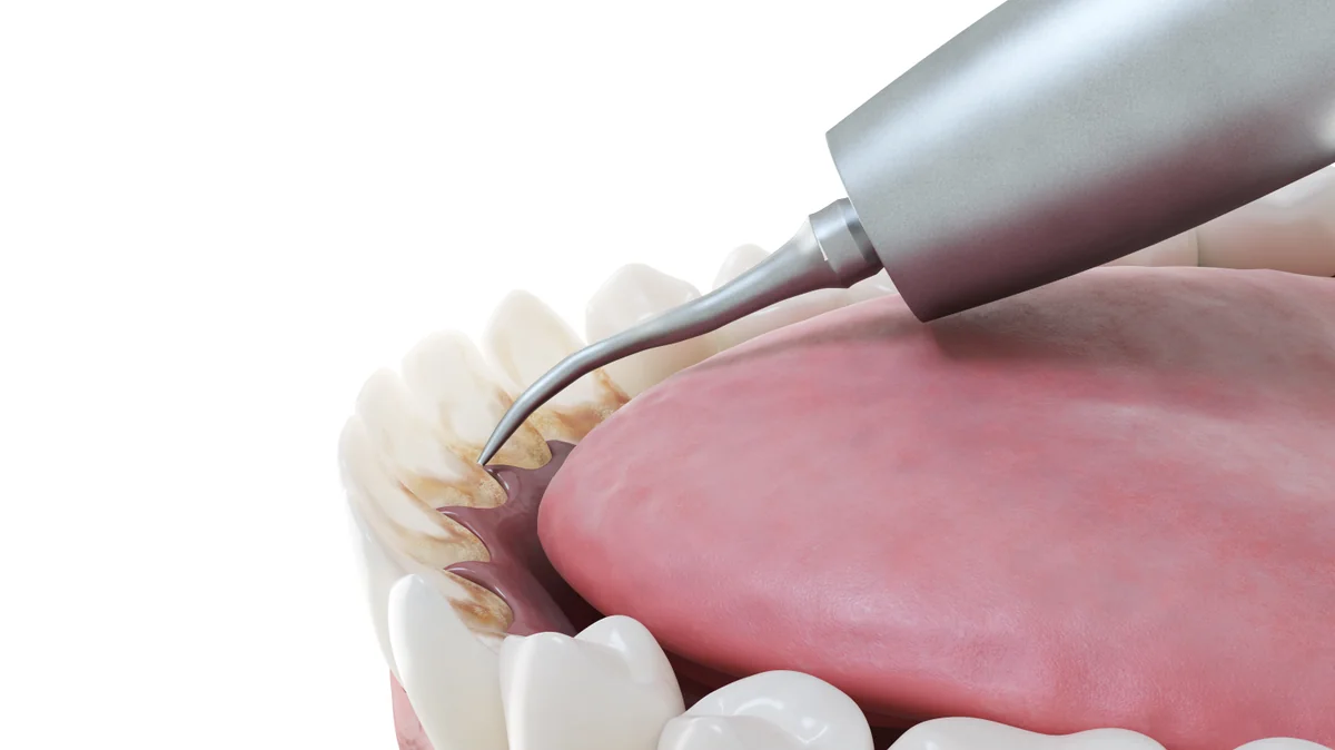 Detartraj profesional Denteca Smile Clinic Detartraj profesional la Denteca Smile Clinic, București, pentru dinți sănătoși