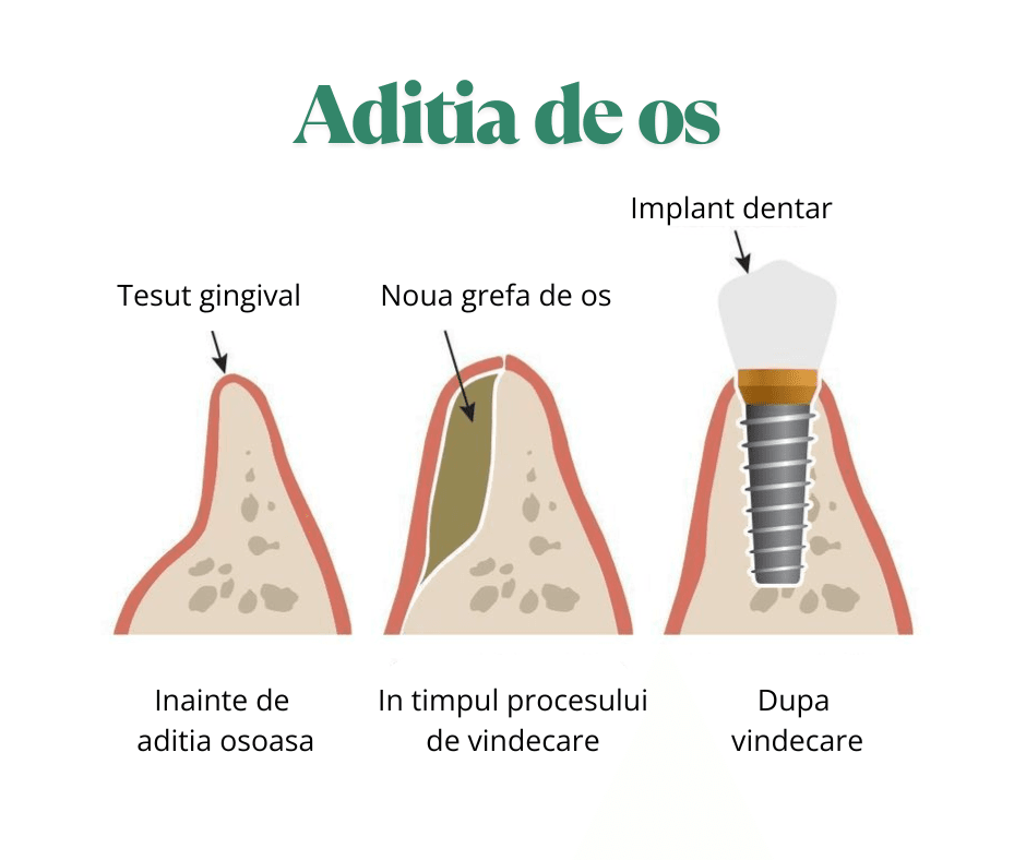 Schema care ilustreaza procesul de aditie osoasa: de la lipsa osului pana la vindecare si inserarea implantului dentar