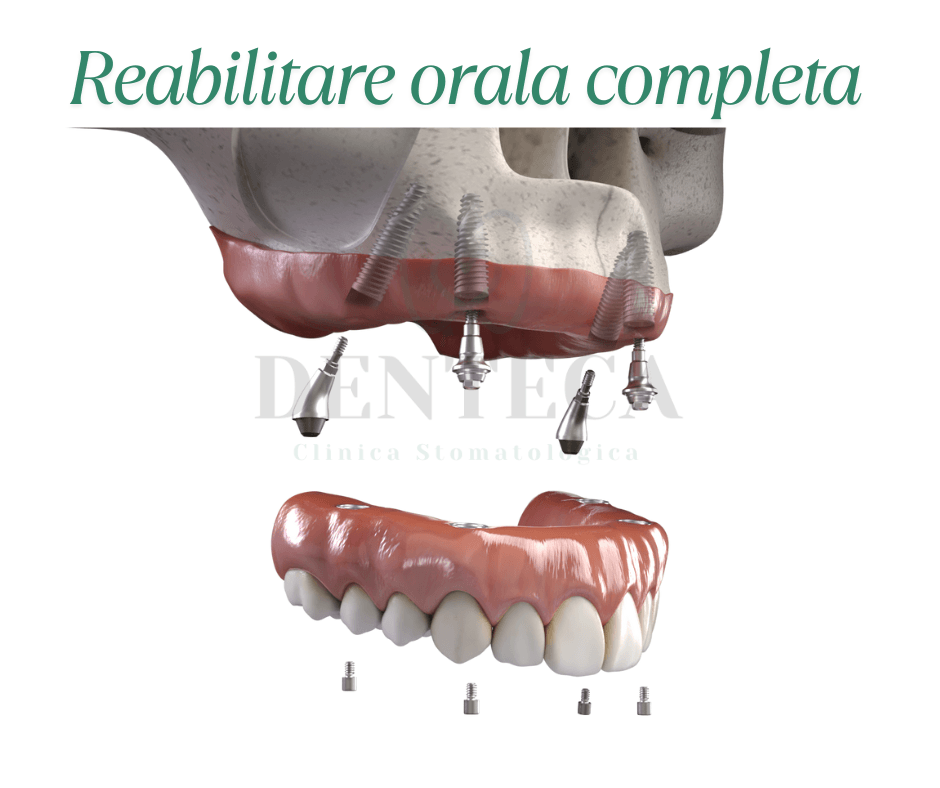 Model 3D care arata o reabilitare orala completa cu implanturi dentare, prin sistemul All-on-4 sau All-on-6