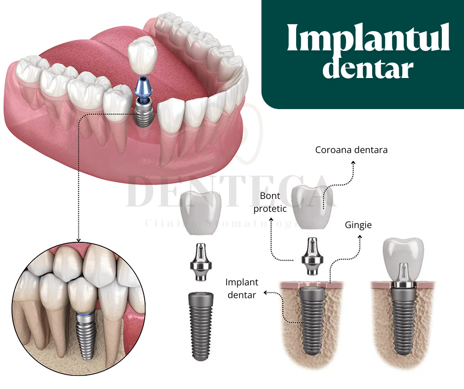 Schema care explica din ce este alcatuit un implant dentar: coroana dentara, bont protetic si surubul implantului inserat in os