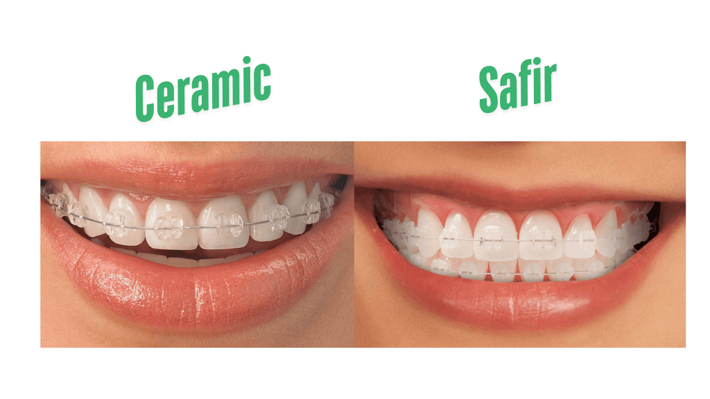 Imagine comparativă între aparatul dentar ceramic și cel din safir, evidențiind diferențele estetice și de transparență.